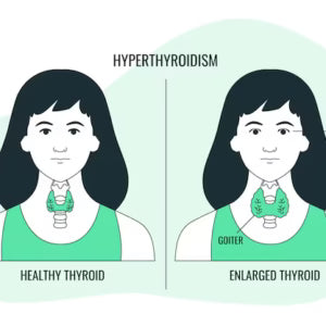 Anemia in Hypothyroidism vs. Normal Anemia