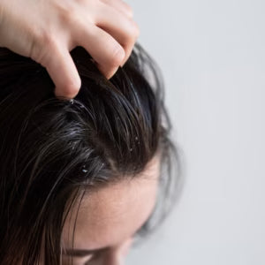 Salicylic Acid for Dandruff & Scalp Acne