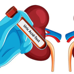 Kidney Stones: Causes & Prevention