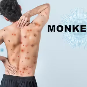 What is Monkeypox? Symptom, causes and Treatment!